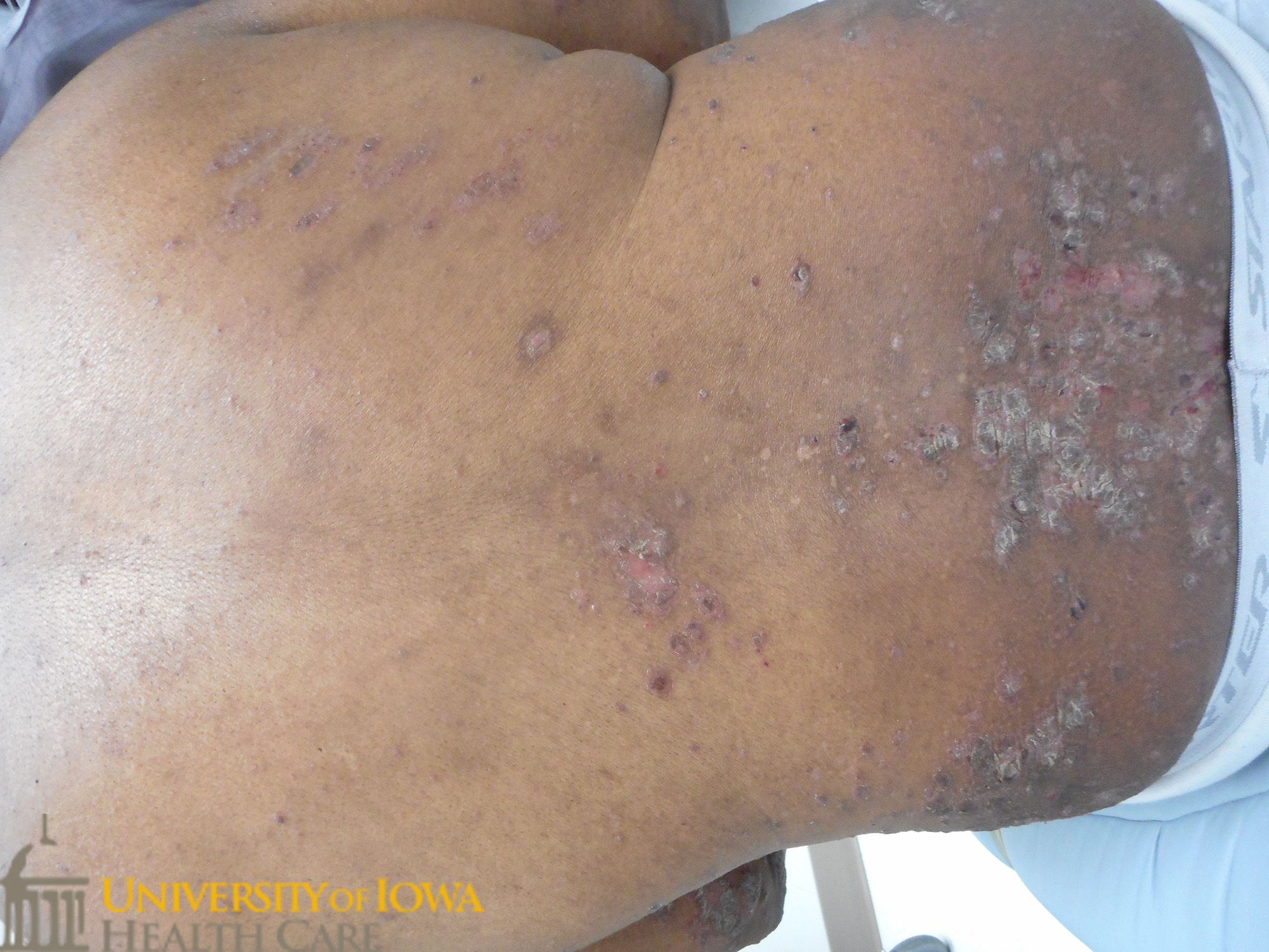 Pink to gray thick scaly papules and plaques on the back. (click images for higher resolution).